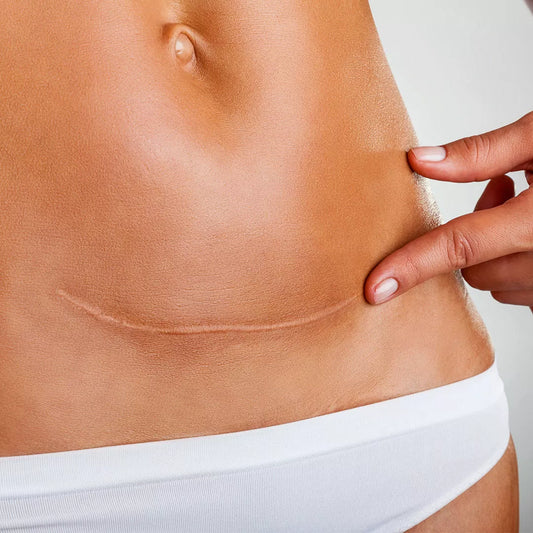 Body Oil & C Section Recovery Tips from Real Mamas