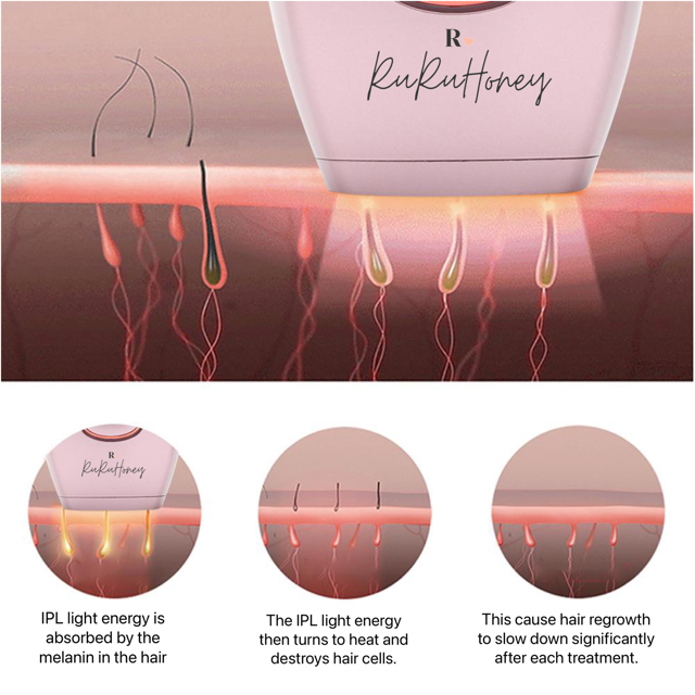 How Does IPL Hair Removal Work?