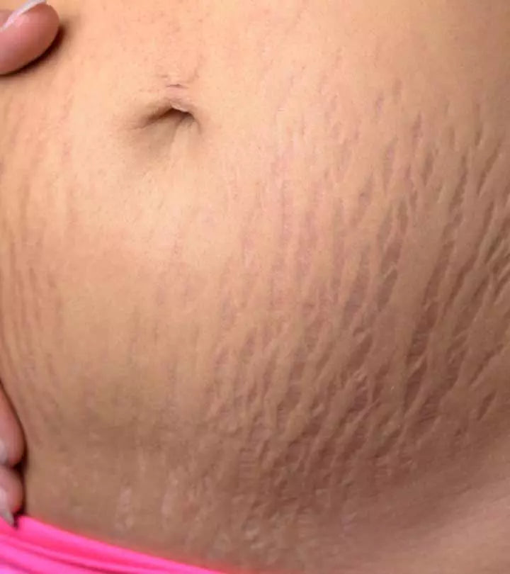 Stretch Marks at Every Stage of Life: Pregnancy, Weight Change, Perimenopause & More